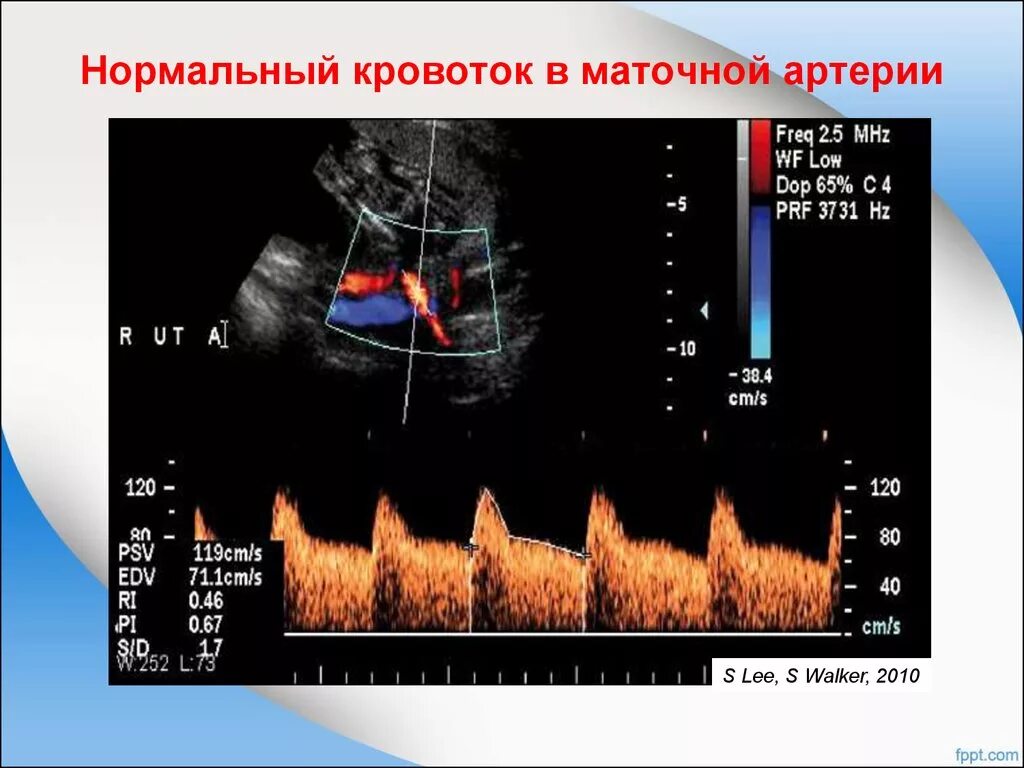 Нормальному кровообращению. УЗИ допплер маточно плацентарного кровотока. Скорость кровотока в маточной артерии при беременности. Нарушение кровотока в маточных артериях при беременности. Допплерография плацентарного кровотока нормы.