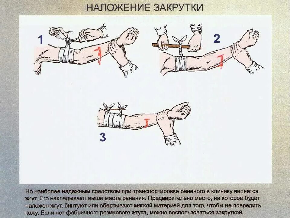 Наложение жгутов при отеке легких алгоритм. Наложение жгута при венозном кровотечении. Места наложения жгута при кровотечении. При каком виде кровотечения необходимо наложить жгут