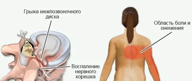 Грудной остеохондроз ощущения. Боли при грудном остеохондрозе. локализация боли при остеохондрозе грудного отдела. локализация боли при грудном остеохондрозе. остеохондроз грудного отдела симптомы у женщин.