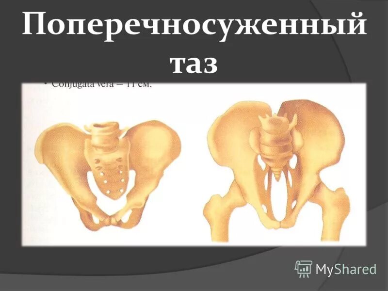 Поперечный таз. Поперечносуженный таз. поперечно суженный иаз. поперечно скженный таз. поперечно суженный таз.