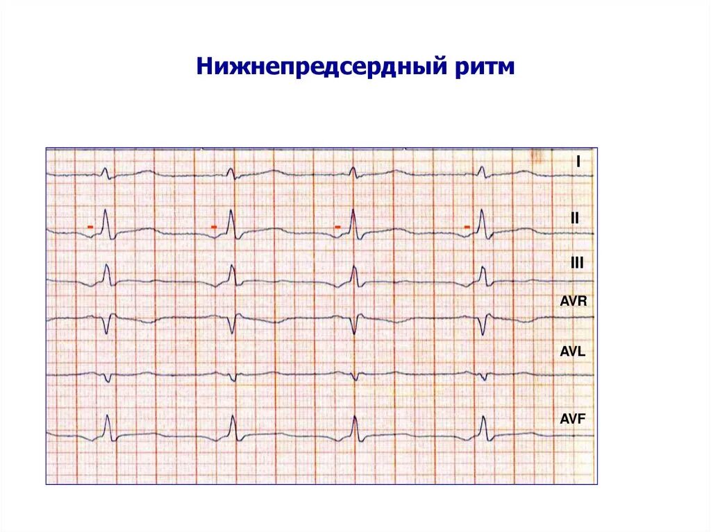 ЭКГ при предсердном ритме. Нижнепредсердный ритм на ЭКГ. Ускоренный нижнепредсердный ритм на ЭКГ. ЭКГ заключение нижнепредсердный ритм. Эктопический предсердный ритм что это