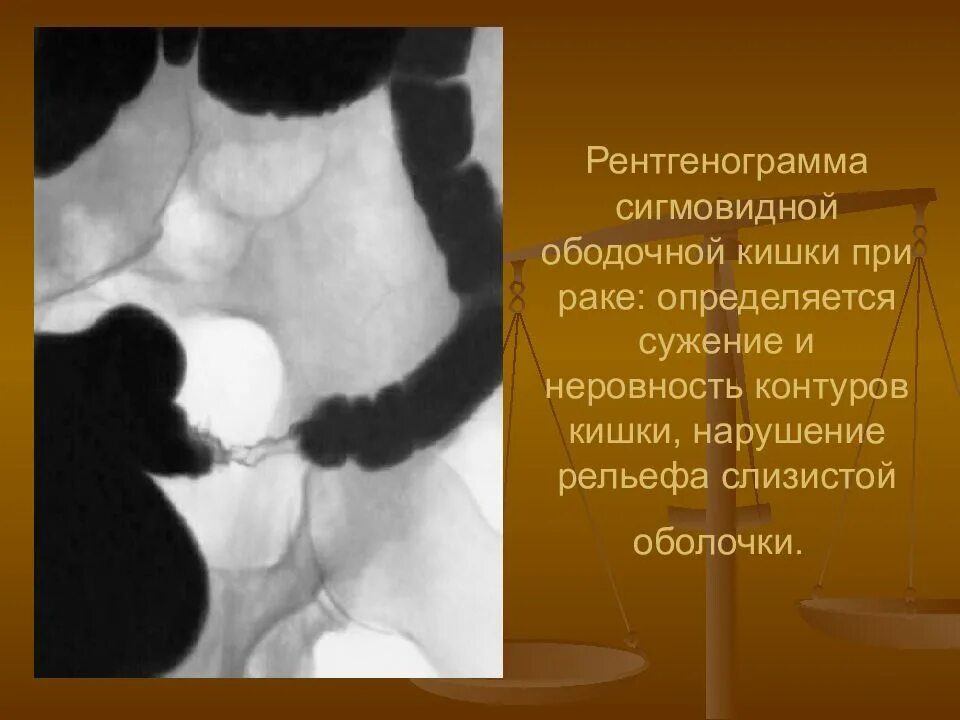 Образование сигмавидной кишкина кт. Карцинома прямой кишки выживаемость. Отделы толстого кишечника ректосигмоидный. Операции при опухоли сигмовидной кишки. Опухоли сигмовидной кишки диф диагностика.
