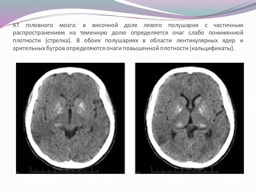 Что значит очаг в головном мозге. Очаг пониженной плотности в головном мозге на кт. Лентикулярные ядра головного мозга на кт. Гиподенсивный очаг кт головного мозга. Базальные ядра головного мозга кт.
