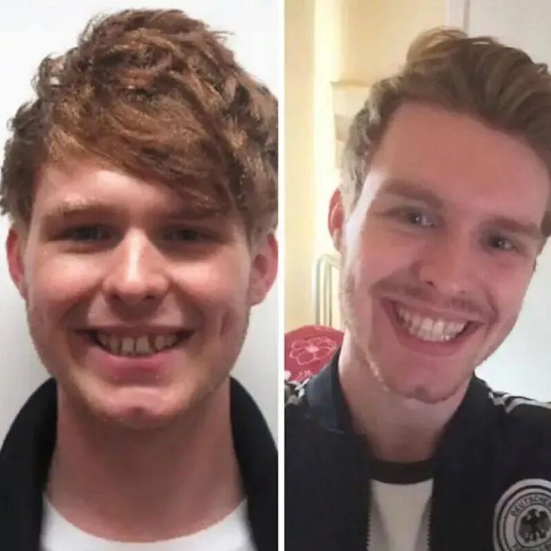 брекеты изменяющие лицо