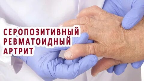Серопозитивный ревматоидный артрит