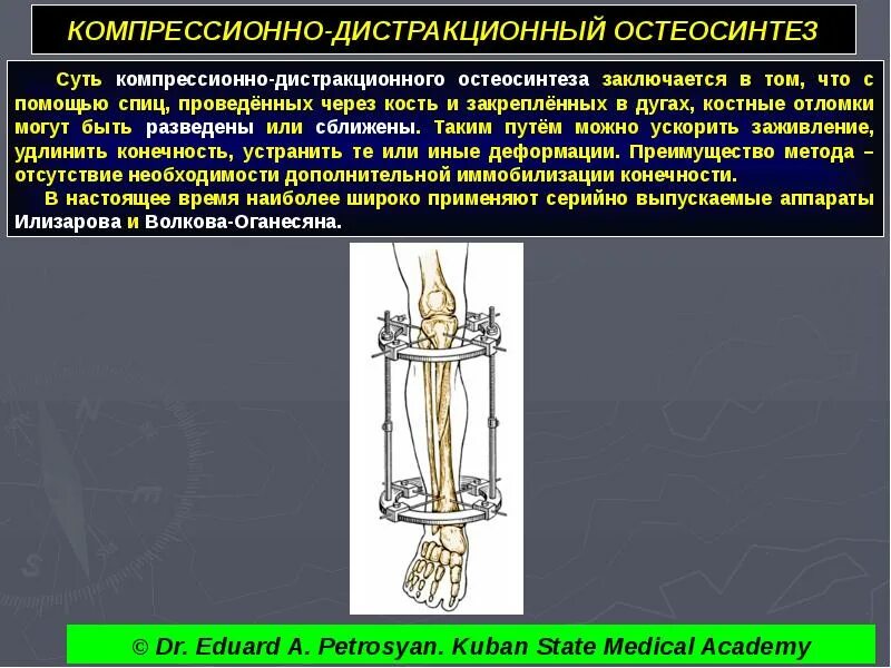 Дистракционная остеосинтез. Дистракционная остеосинтез. Дистракционная остеосинтез. Чрескостный компрессионный остеосинтез. Внеочаговый компрессионно-дистракционный остеосинтез аппаратами.