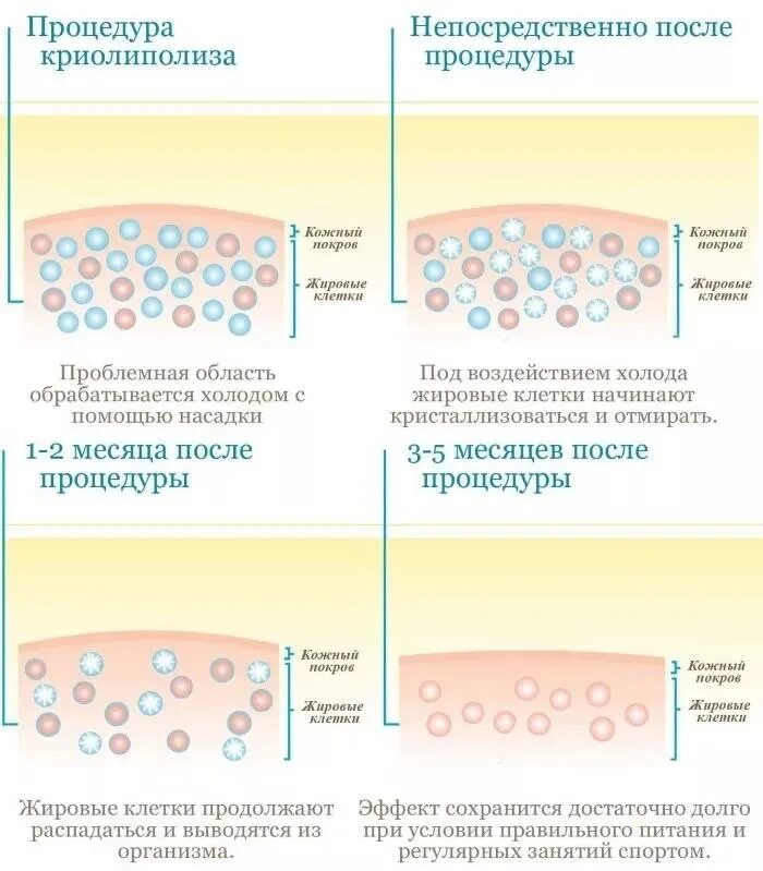 Криолиполиз. Побочная реакция криолиполиз. Криолиполиз процедура. Криолиполиз это простыми словами. Криолиполиз 4 манипулы одновременно.