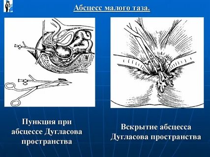 Дугласовое пространство у женщин