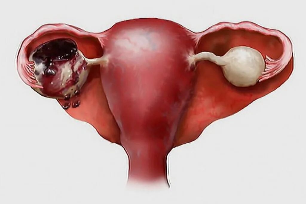 Апоплексия кисты яичника. Апоплексия, разрыв яичников. Апоплексия капсулы яичника. Тотальная матка