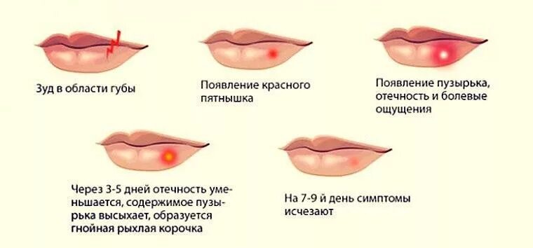 Стадии появления герпеса.