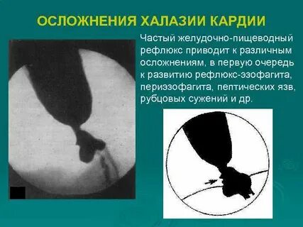 Халазия