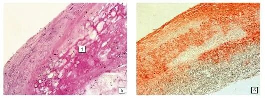 Атеросклероз микропрепарат. Атеросклероз микропрепарат. Окраска суданом iii-гематоксилином. Атеросклероз сосудов гистология. Атеросклероз аорты гистология.