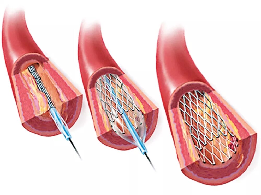 Сколько стоит стент. Стентирование сосудо сердце. Операция стентирование сосудов сердца. Холестериновые бляшки стентирование. Коронарная ангиопластика и стентирование.