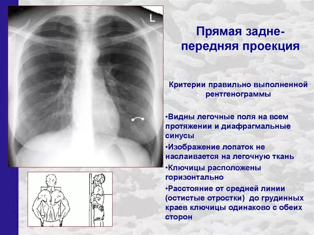 Грудная клетка в передней прямой проекции рентген. Рентген ОГК задняя и передняя проекции. Передне задняя проекция рентген легких. Прямая задняя проекция грудной клетки рентген. Легкие в прямой проекции