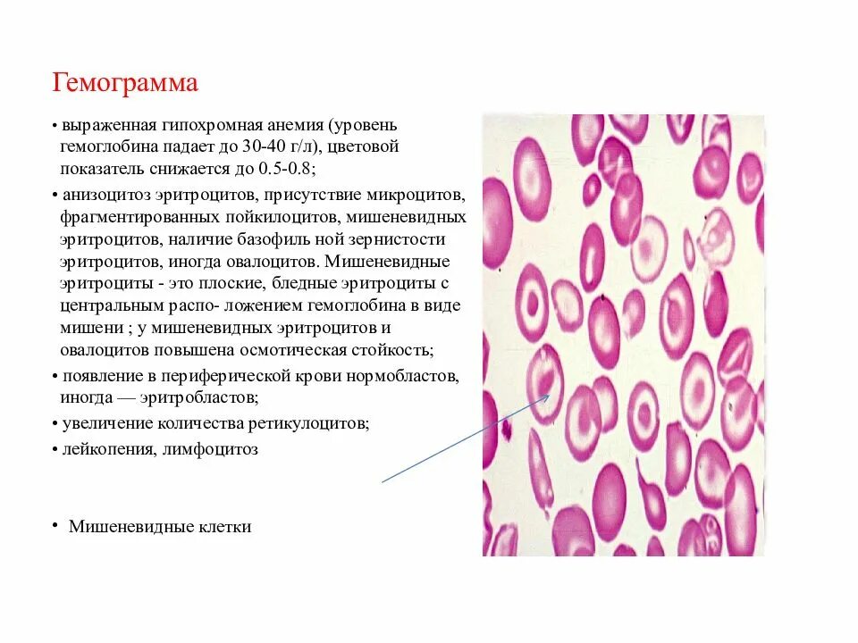 Микроциты повышены. Анизоцитоз эритроцитов. Микроциты. Анемии гемограмма. Заключение по гемограмме.