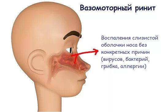 Заложенность носа и течет. Вазомоторный ринит цвет слизистой оболочки. Вазомоторный риносинусит. Вазомоторный ринит нос.
