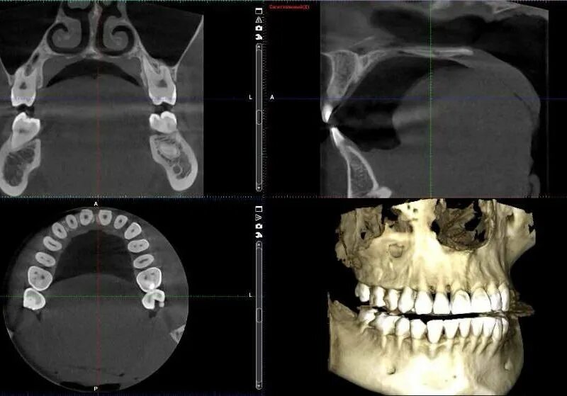 Кт нижней челюсти цена в ульяновске. Кт 15х15 верхней и нижней челюсти. Кт 3d верхней и нижней челюсти. Компьютерная томография кт челюсти.
