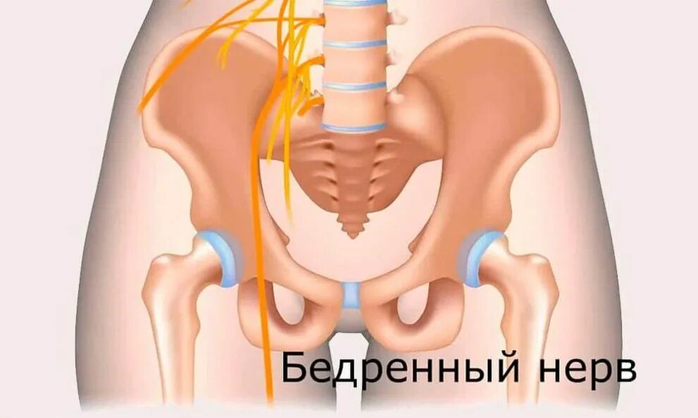 Невропатия тазобедренного нерва.