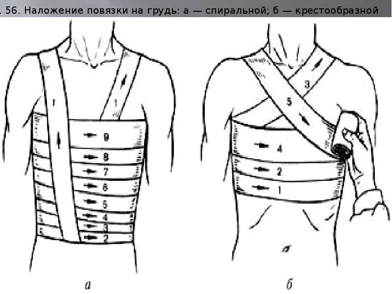 Спиральная повязка алгоритм. Крестообразная восьмиобразная повязка на грудную клетку. Наложение первичной повязки на грудь восьмиобразная. Повязки на туловище десмургия. Десмургия восьмиобразная повязка.