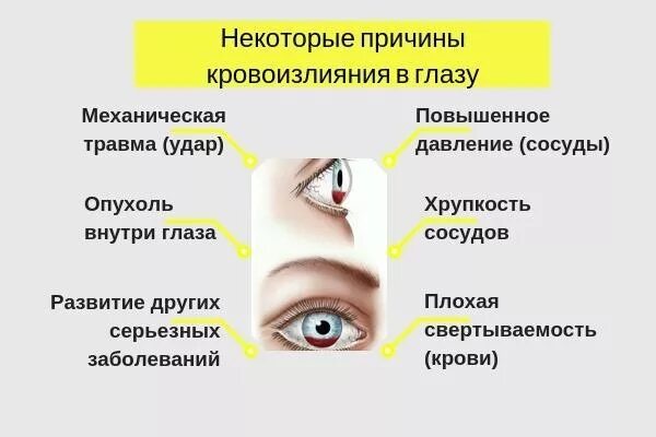 Кровоизлияние внутри глаза. Кровоизлияние в глаз причины. Кровоизлияние в угол глаза.