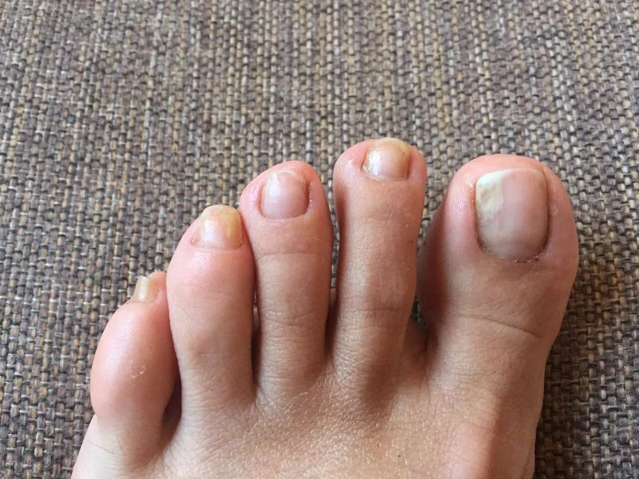 Педикюр грибковых ногтей. Здоровые ногти на ногах. Ктолщение ногтей натногах.