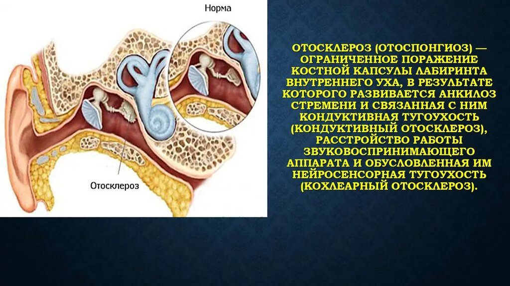 Отосклероз уха операция. Кондуктивный отосклероз. Отосклероз стапедопластика.