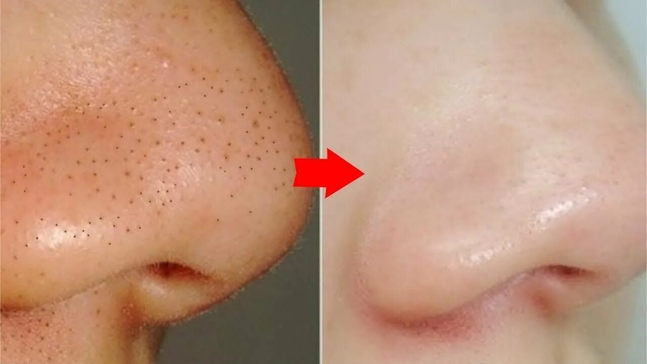 Чистка лица от прыщей и угрей