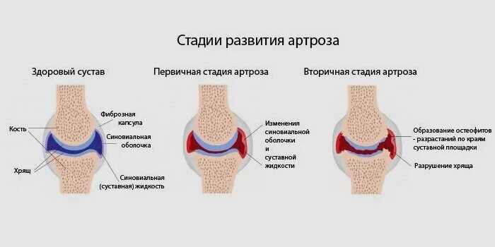 Артроз коленного сустава 1 степени что это. Деформирующий артроз коленного сустава схема. деформирующий артроз 1-2 степени. артрит коленного сустава схема. стадии развития деформирующего остеоартроза.
