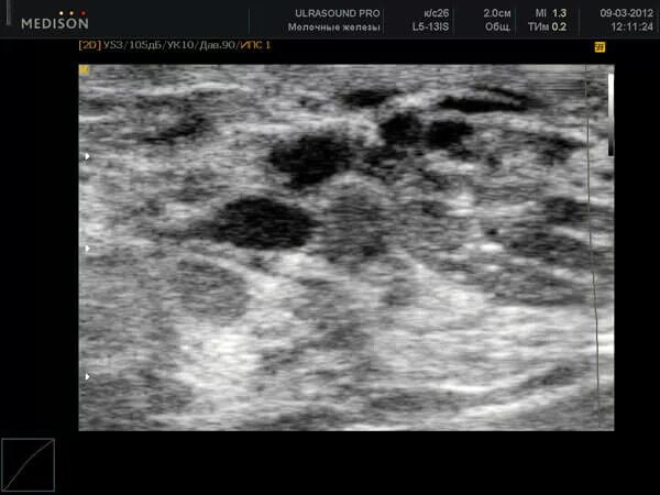 Железы кистозно расширены. Фиброзно кистозная мастопатия молочной железы УЗИ. Фиброзная мастопатия молочных желез на УЗИ. Кистозная мастопатия молочных желез на УЗИ. УЗИ Узловая фиброзно-кистозная мастопатия.