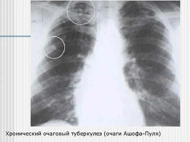 Очаговый туберкулез рентген. Очаговый туберкулез легких рентген. Мягкоочаговый туберкулез легких рентген. Очаговый туберкулез легкого рентген.