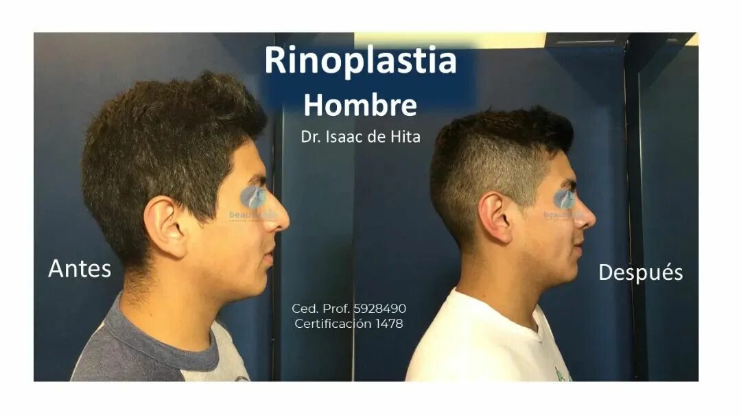 Cuanto cuesta una rinoplastia en españa