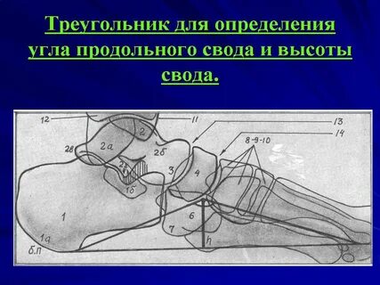 Плоскостопие рентген измерение