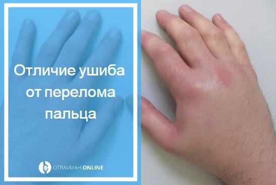 Как отличить ушиб от трещины. Отличить перелом пальца от ушиба. отличие перелома пальца от ушиба. как отличить ушиб от перелома пальца. ушиб от перелома пальца.