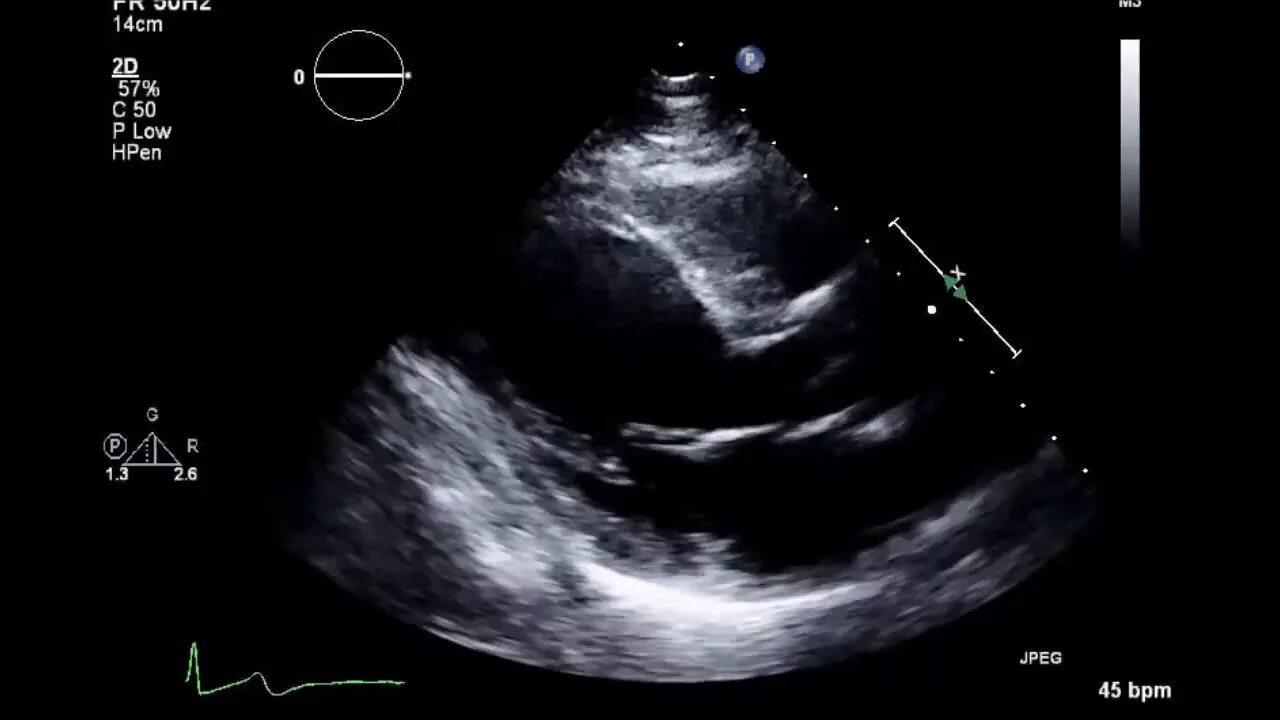 Быстро эхо. Эхокардиография гиф. Эхокардиография миокардит. Перикардит на Эхо гиф. Measurement of ejection fraction on Echocardiography.