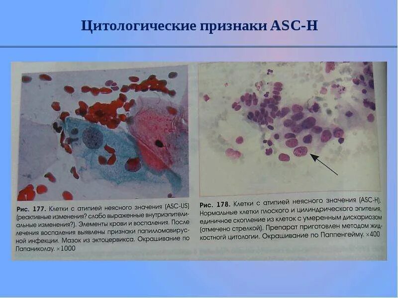 Реактивные изменения эпителия эндоцервикса. Цитологическое исследование гинекологических мазков. дискариоз клеток плоского эпителия. атипия клеток плоского эпителия шейки матки. цитологическое исследование тканей матки.