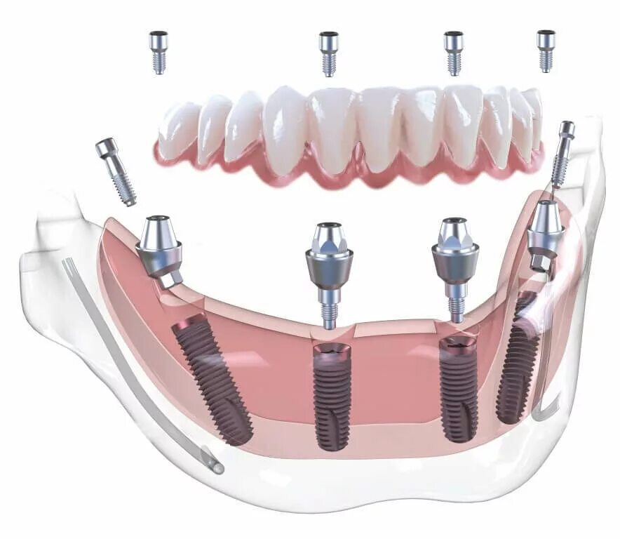 All on 4 имплантация Нобель. Имплантологическая кассета Nobel полный набор для all on 4. Технология протезирования зубов all-on-4. Тигразубик