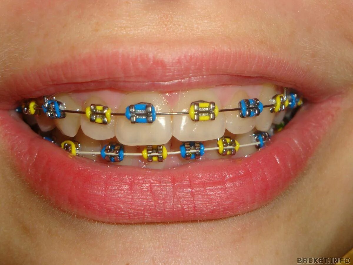 Чейн цепочка ортодонтия. Металлические лигатурные брекеты mini diamond. Разноцветные лигатурные брекеты. Металлические лигатурные брекеты mini diamond. Сапфировые брекеты лигатурные.