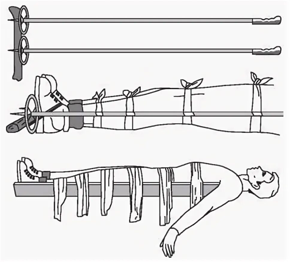 Перелом голени транспортировка. Перелом голени транспортная иммобилизация. Перелом бедра транспортная иммобилизация. Транспортная иммобилизация большеберцовой кости. Перелом берцовой кости иммобилизация.