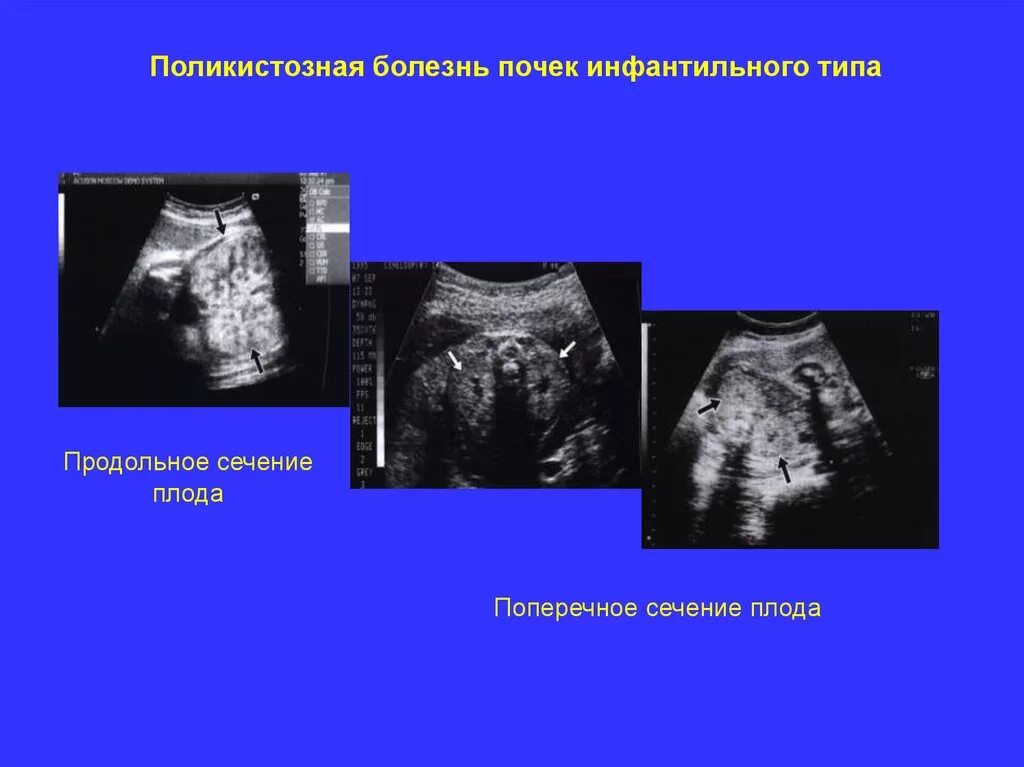 Почки у плода 20 недель. Аутосомно-рецессивная поликистозная болезнь почек УЗИ. Аутосомно-доминантный поликистоз почек УЗИ. Поликистоз почек у плода на УЗИ. Инфантильный Тип поликистоза почек УЗИ.