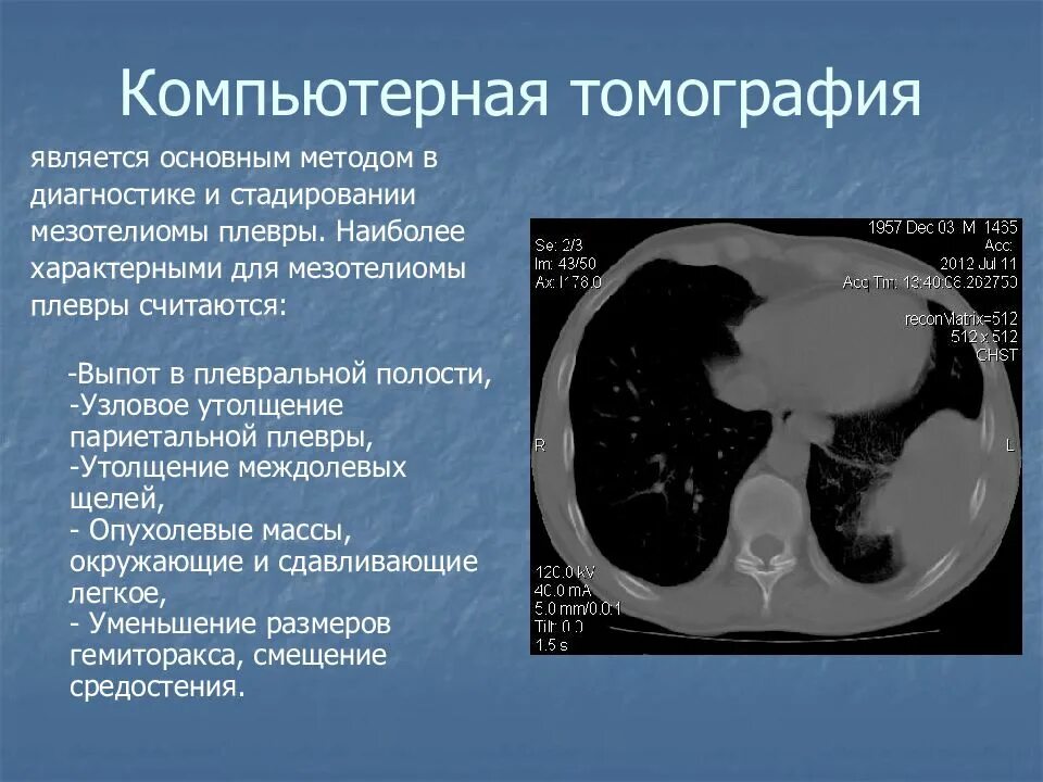 Жидкость в плевральной полости кт. Объем жидкости в плевральной полости по кт. Туберкулезный плеврит кт. Осумкованный плеврит на кт. Экссудативный плеврит кт.