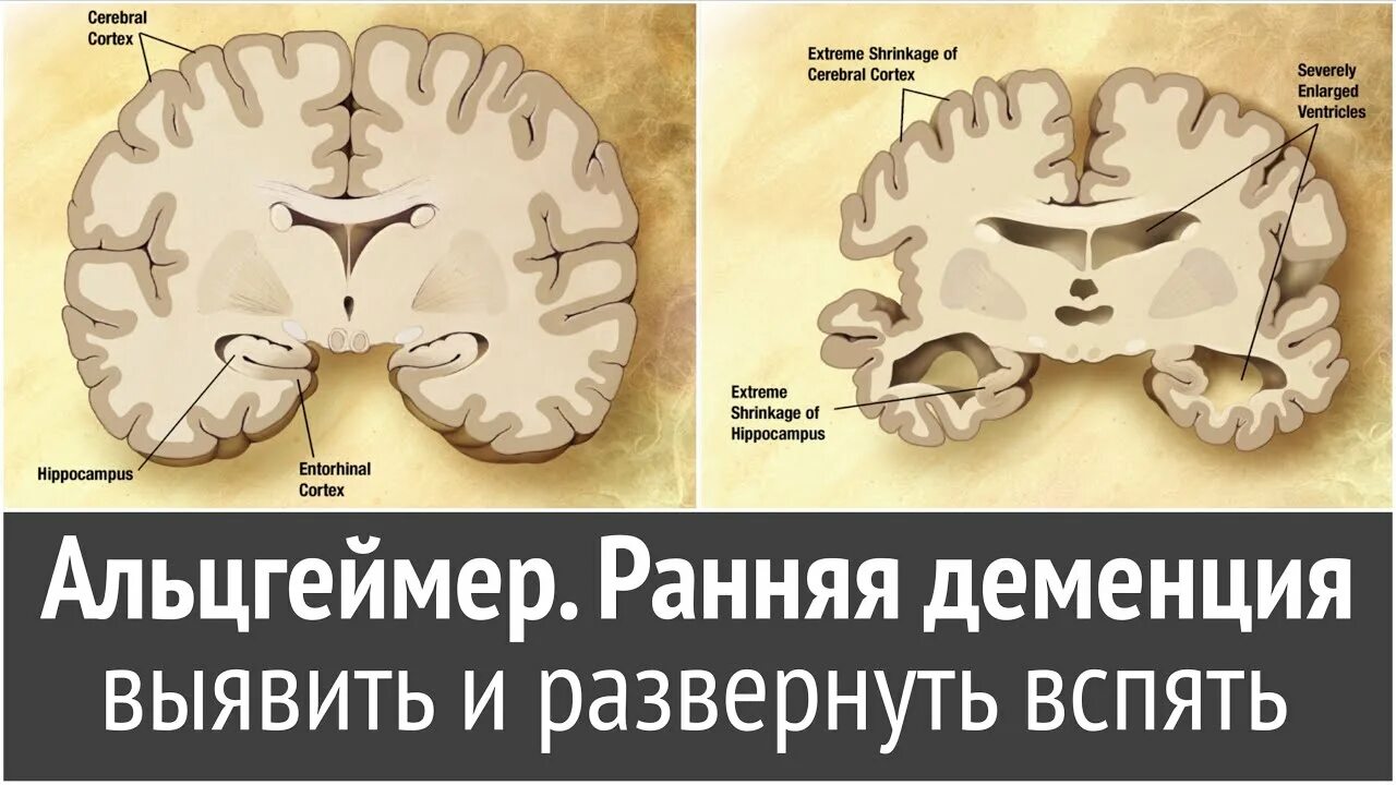 Атрофия головного мозга лечение. Головной мозг при болезни Альцгеймера. Атрофия коры головного мозга. Деменция и атрофия мозга.
