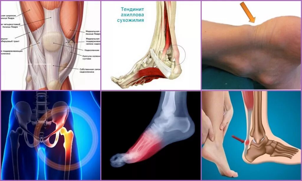 Тендинит ахиллова сухожилия. Тендинит ахиллова стопы. Тендинит тазобедренного сухожилия. Оссифицирующий тендинит ахиллова сухожилия.