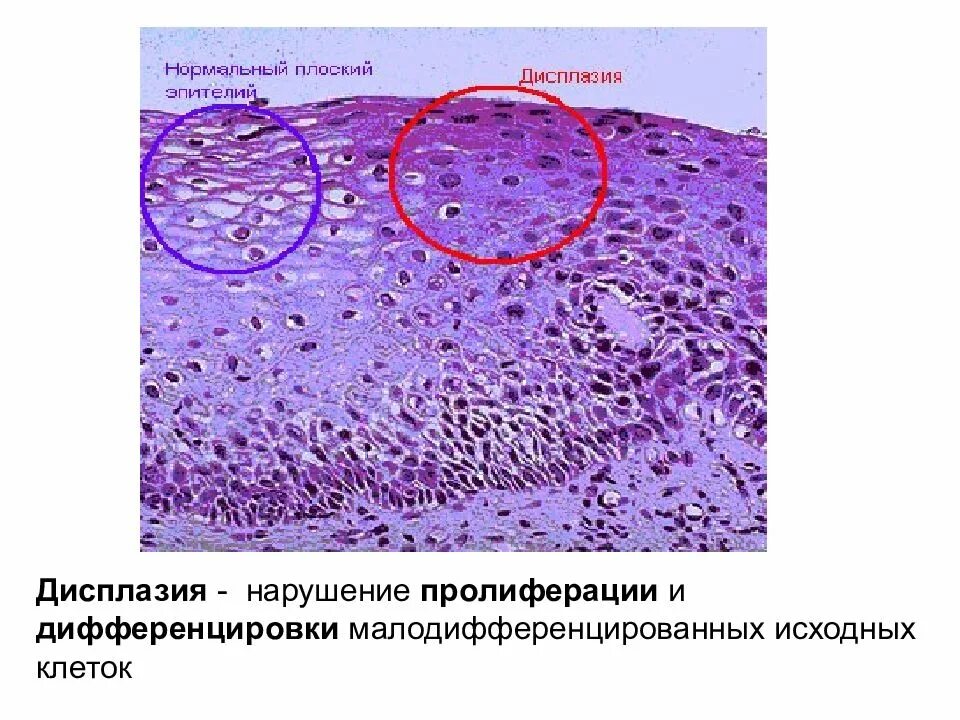 Нарушение дифференцировки клеток. Малодифференцированные клетки. пролиферация и дифференцировка. пролиферация и дифференцировка клеток.