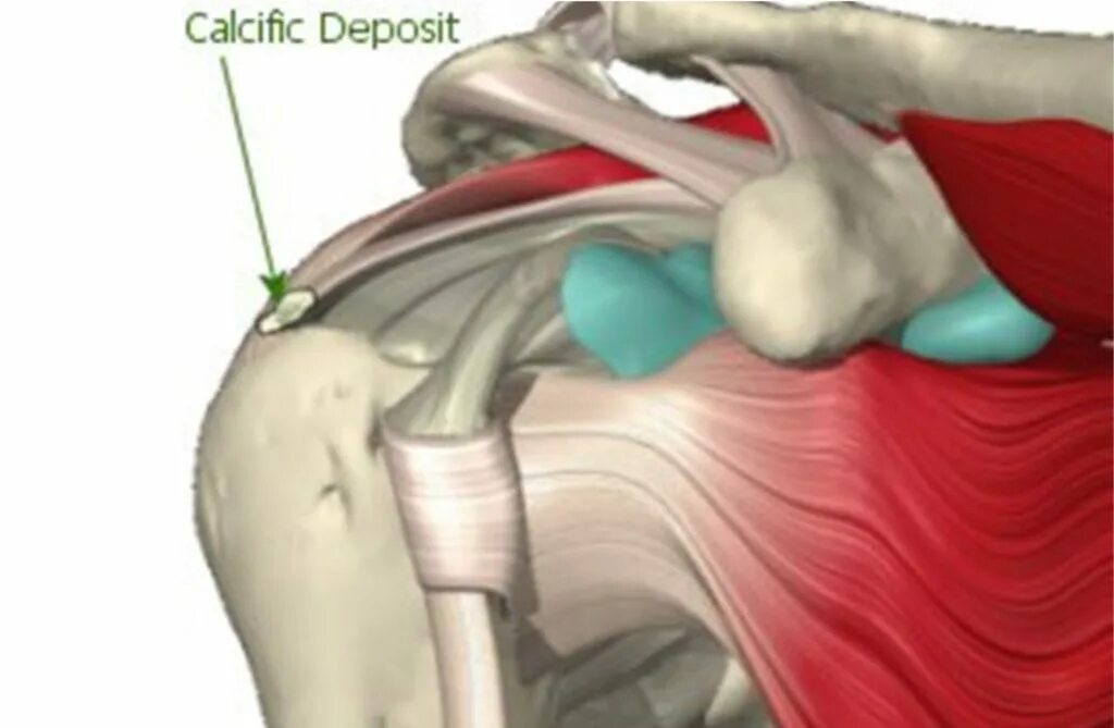 Тендинит сухожилия бицепса плечевого сустава. Надостный тендинит. Теносиновит надостной мышцы. Тендинит сухожилия бицепса.