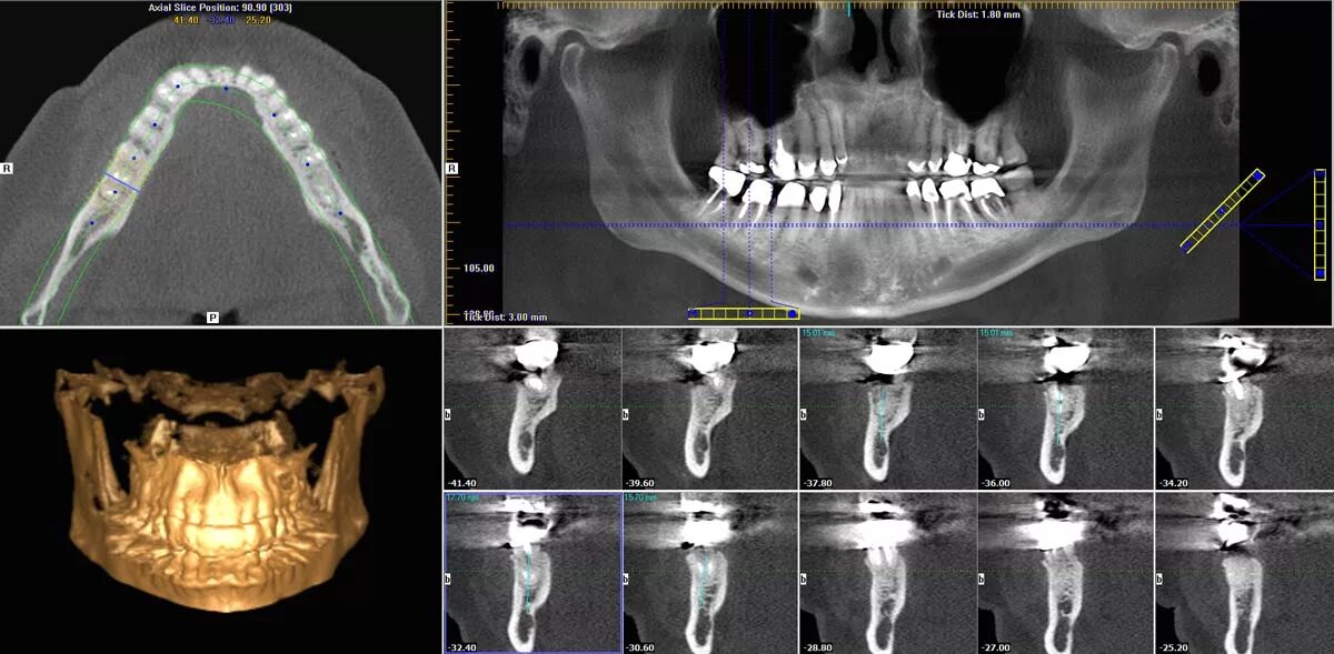 Где сделать кт зуба. Дентальные импланты верхней челюсти кт. Снимок кт зубов пульпит.