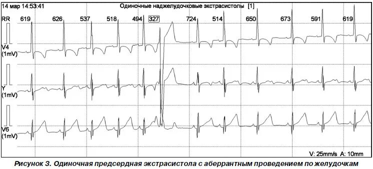 Холтер наджелудочковые экстрасистолы. Наджелудочковая экстрасистолия Холтер. Редкая наджелудочковая экстрасистолия что это такое. Наджелудочковая экстрасистолия на Холтере. Наджелудочковая экстрасистолия на ЭКГ.