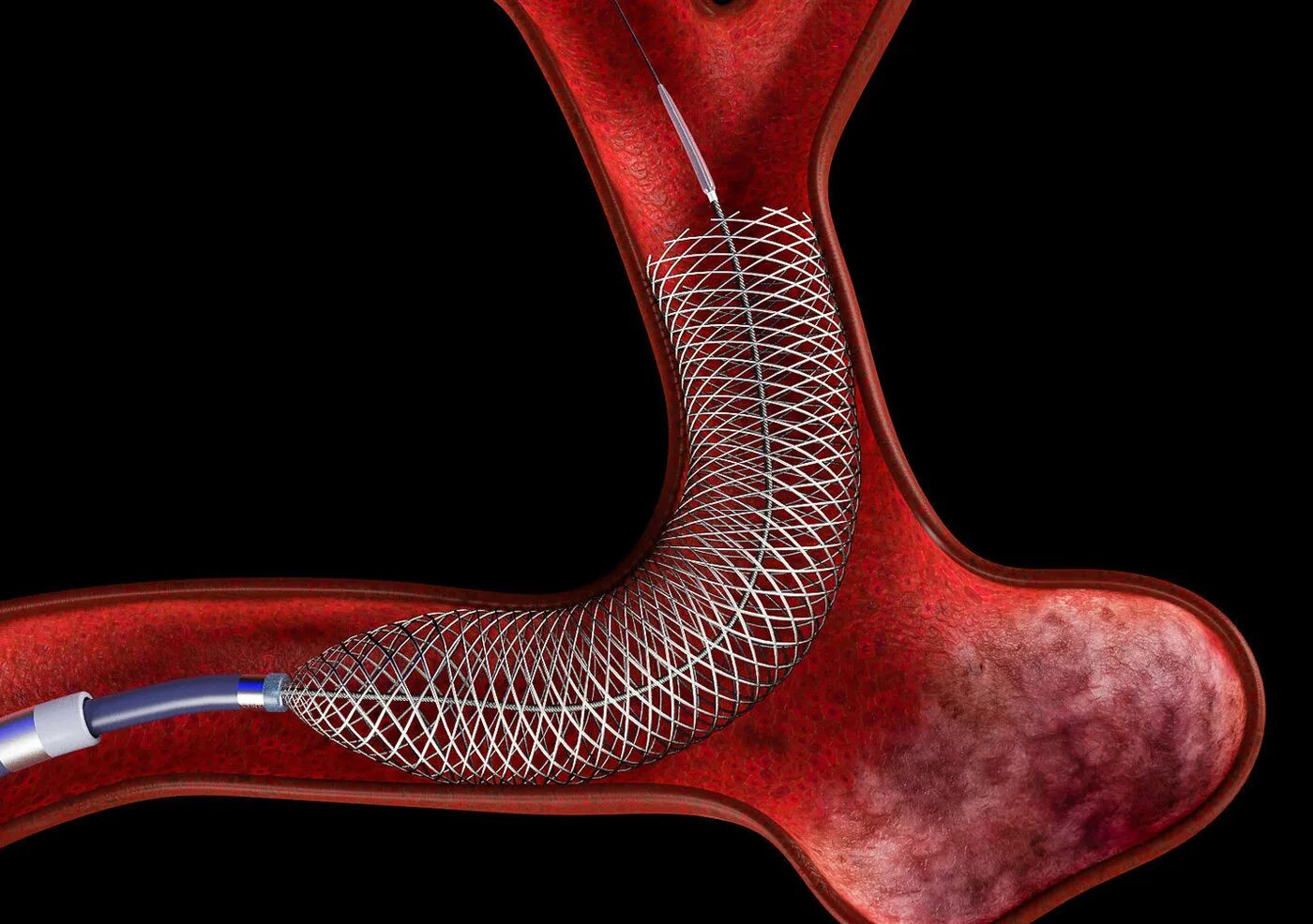 Аневризма стент. Спиральный стент. Рассасывающийся стент.