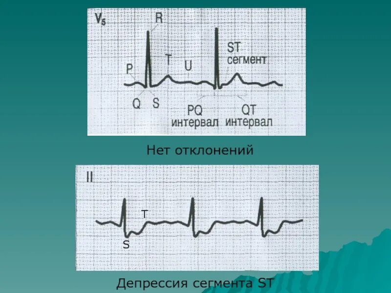 Отрицательный сегмент st. Косонисходящая депрессия сегмента st. депрессия сегмента st при ибс. депрессия сегмента ст на экг. депрессия сегмента st на экг.