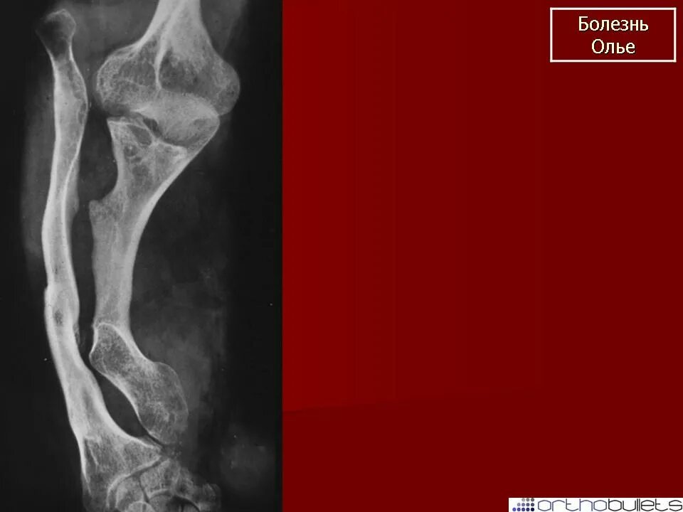 Хондроматоз костей (болезнь оллье). Болезнь олье. Хондроматоз костей (дисхондроплазия). Остеомиелит олье рентген. Болезнь олье.