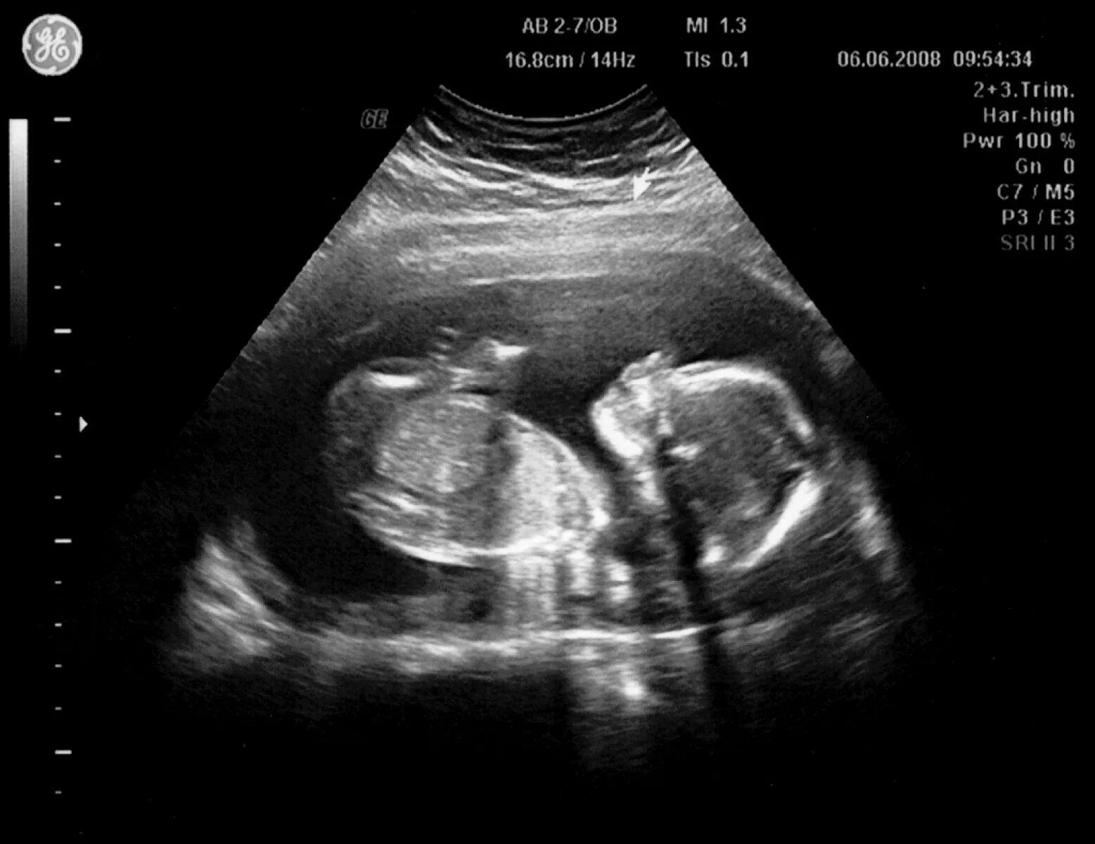 УЗИ 27 недель беременности УЗИ девочка. Беременность двойней УЗИ на 19-20 неделе. УЗИ 19 недель беременности двойня. Малыш на 19 неделе